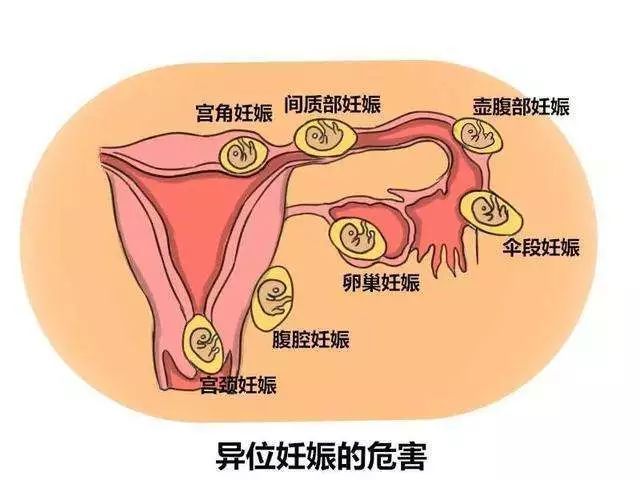 孕妇宫外孕,宫外孕发生在卵巢上症状