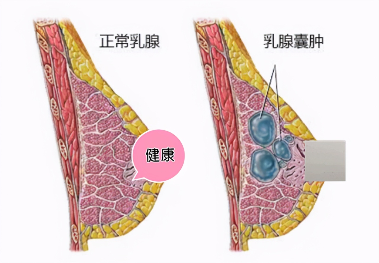 乳腺囊肿和结节哪一个容易癌变,乳腺囊肿在怀孕期会癌变吗