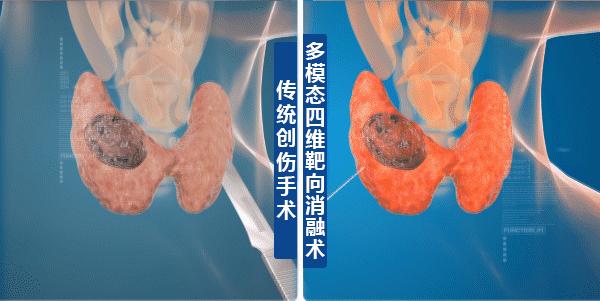如何判断甲状腺结节变好了,甲状腺结节区分良性恶性