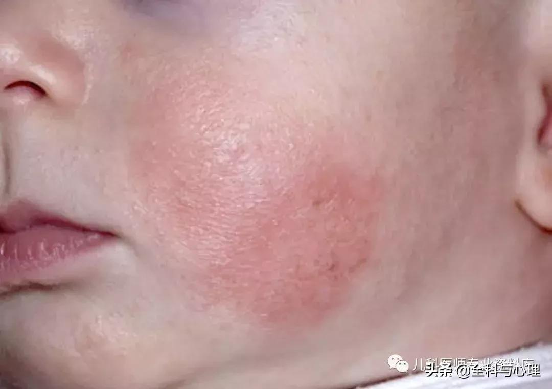 儿童痱子和湿疹，千万要分清楚了