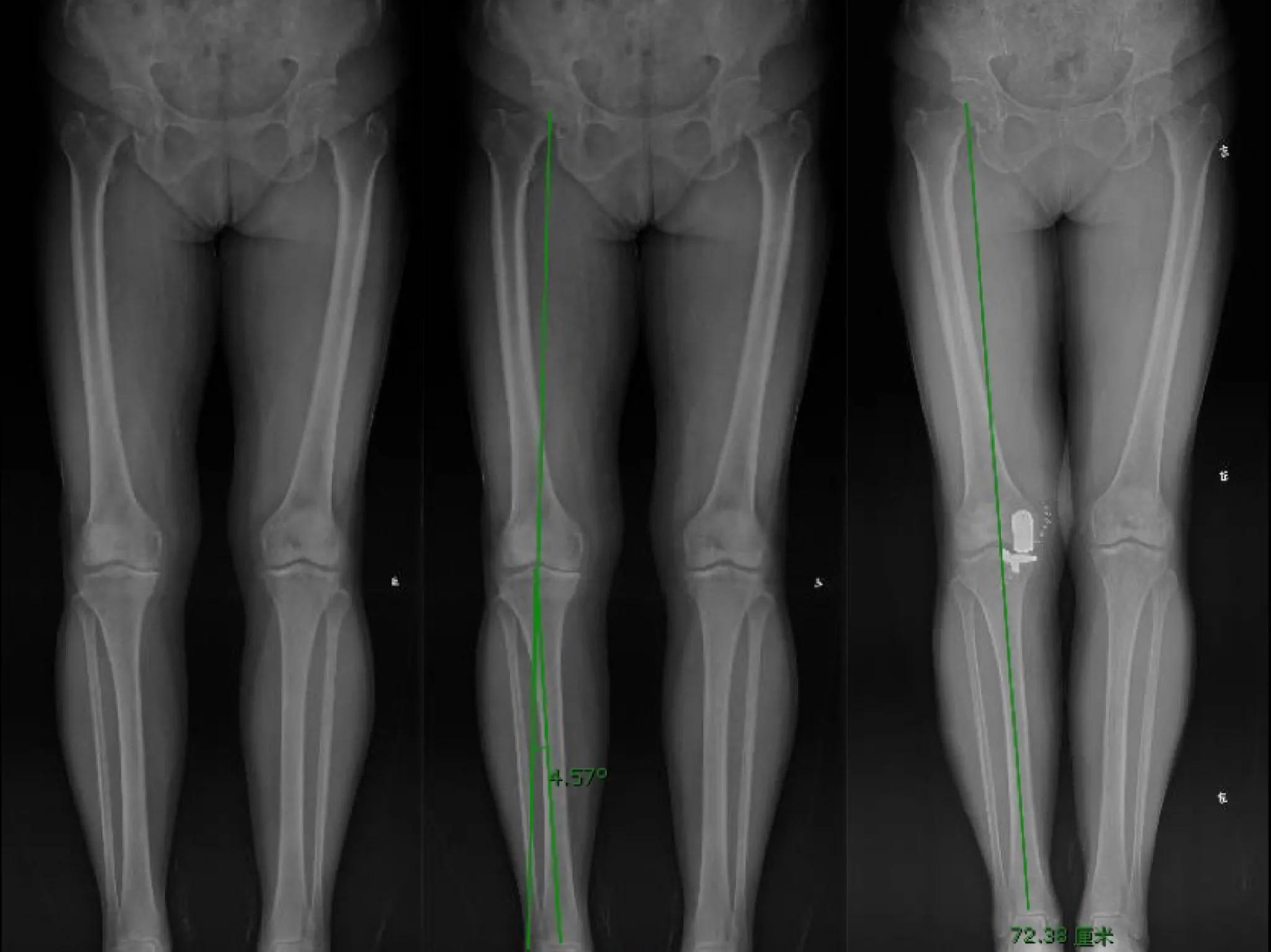 膝关节骨关节炎并内翻畸形如何选择治疗方案？