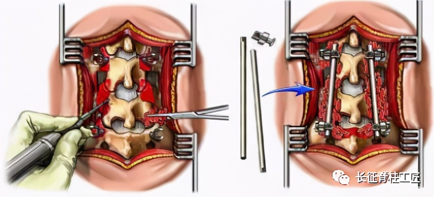 老年人腰椎管狭窄可以微创手术吗,老年人腰椎管狭窄瘫痪