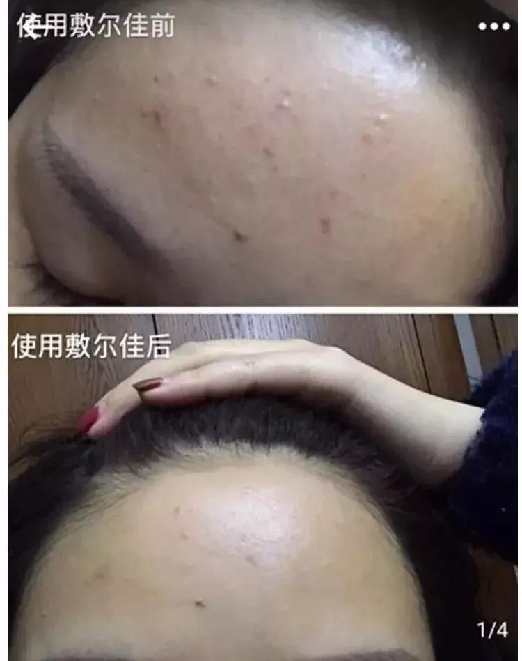 火遍日本的国产面膜,敷尔佳清痘面膜真实测评