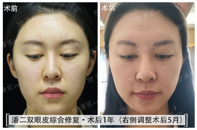 双眼皮失败的女孩,双眼皮失败做成了三眼皮好修复吗