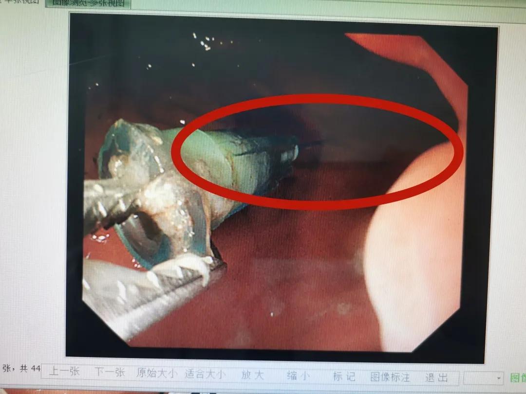 惊险！威海一宝宝吞下注射针头