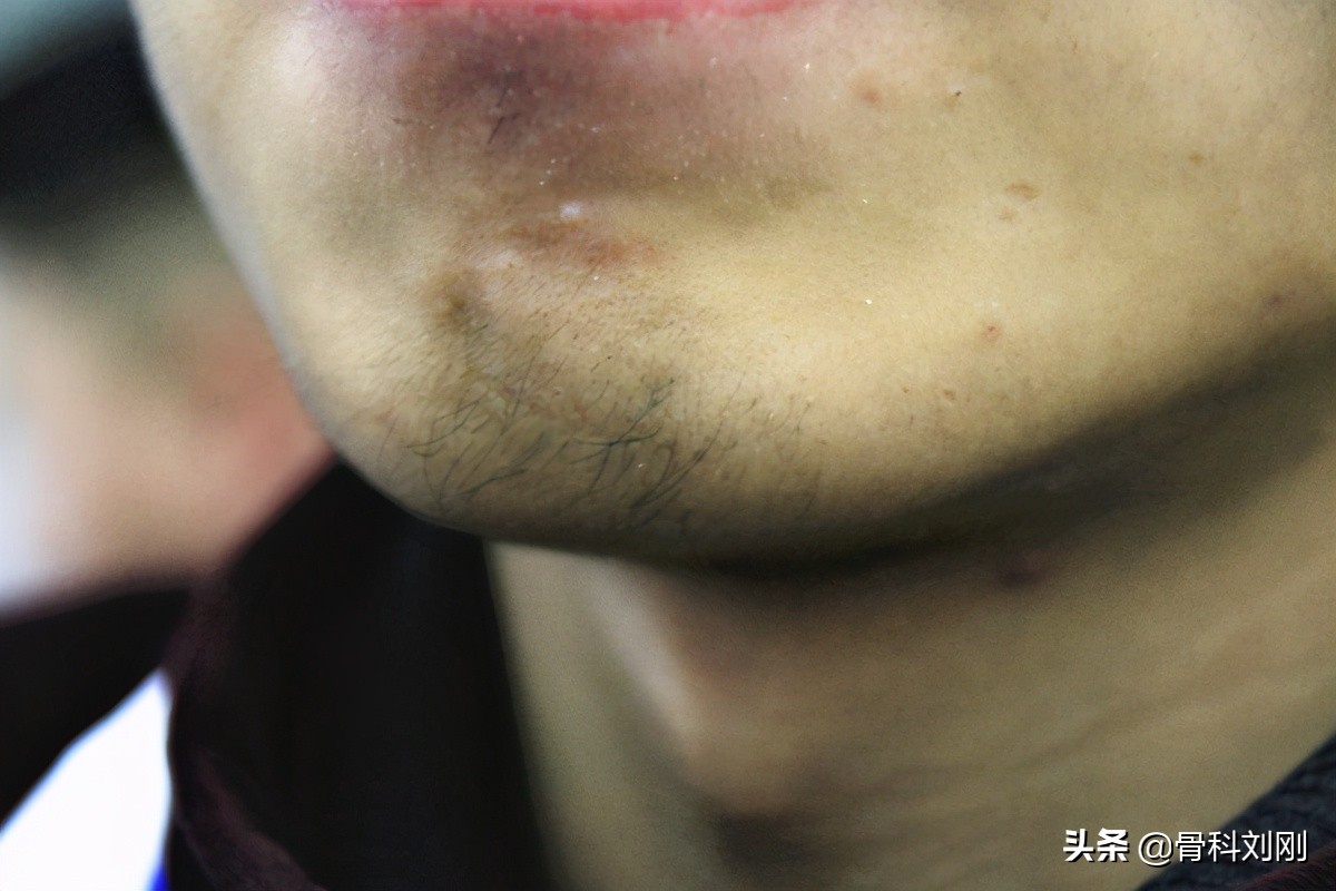 没刮过胡子胡子突然长得快了,刚刮的胡子第二天就长出来了