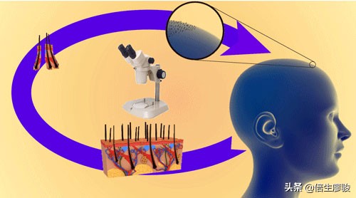 植发对额头的修饰,植发改善秃子
