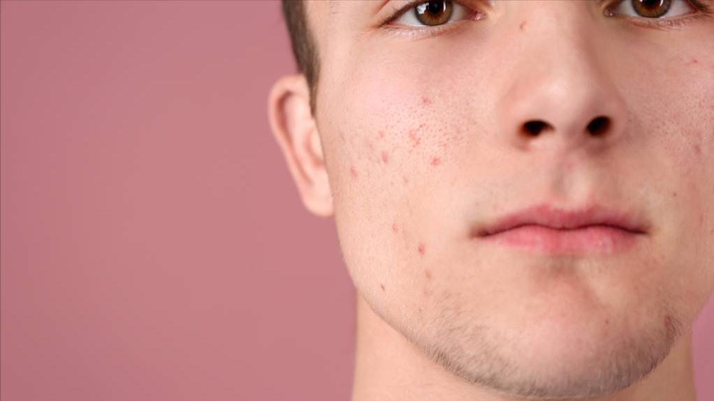 脸上长脓包痘痘快速去掉,脸上长痘痘该怎么调理除湿