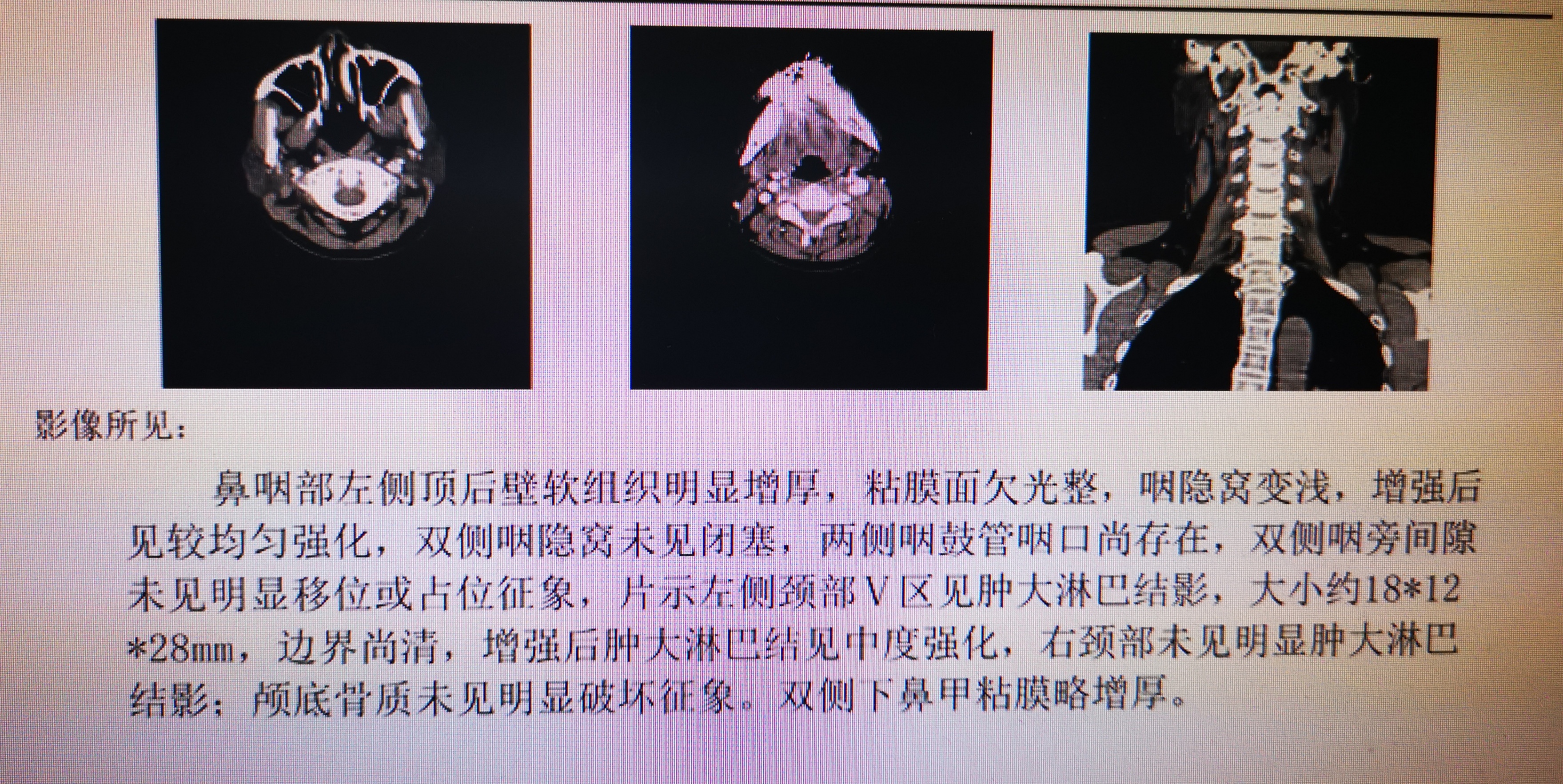 鼻咽癌临床诊断和治疗指南,实例讲述鼻咽癌诊治过程