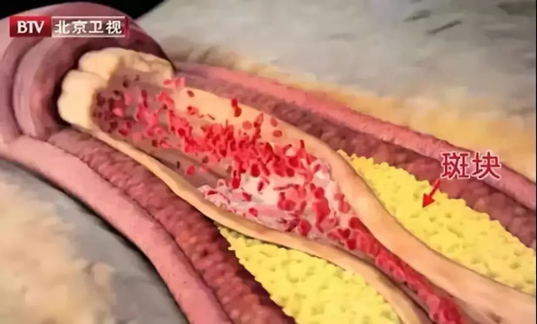 三大征兆很可能是肺栓塞,年轻人留意肺栓塞的五大常见征兆