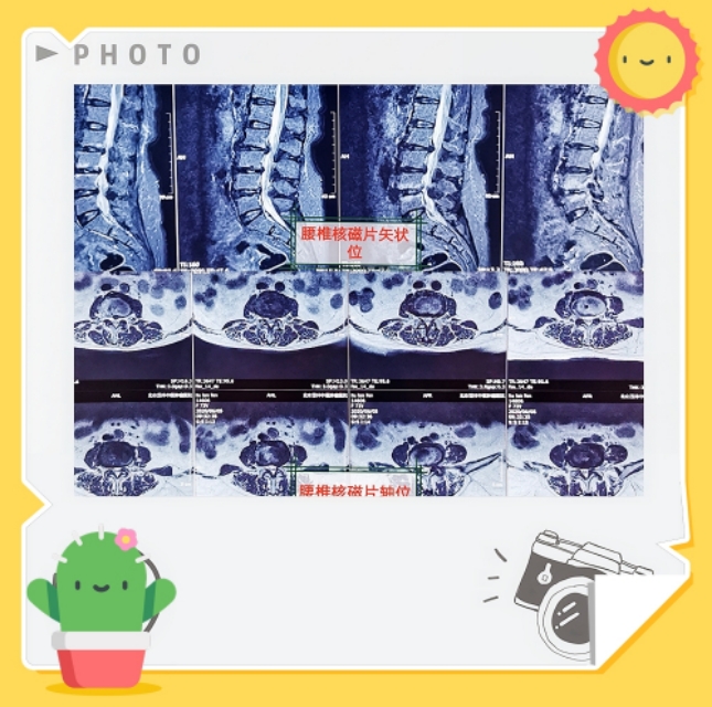 专家治疗腰椎间盘突出症的手法,专家教你快速治疗腰椎间盘突出