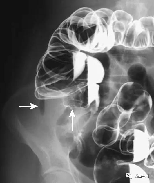 腹部影像图片大全,乙状直肠疼痛位置图片
