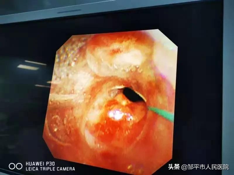 重症肺炎最佳治疗方法,满月宝宝重症肺炎如何治疗