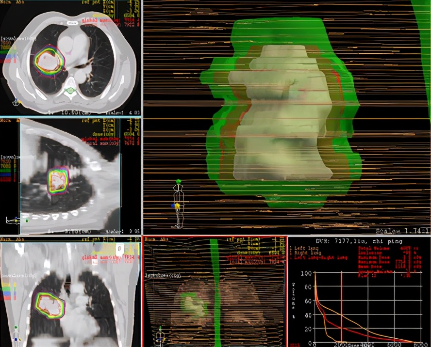 局部放疗能彻底治好吗,放射治疗全过程两大阶段