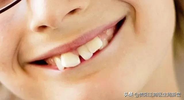 12岁前必须解决的错颌畸形,孩子十二岁牙畸形怎么办