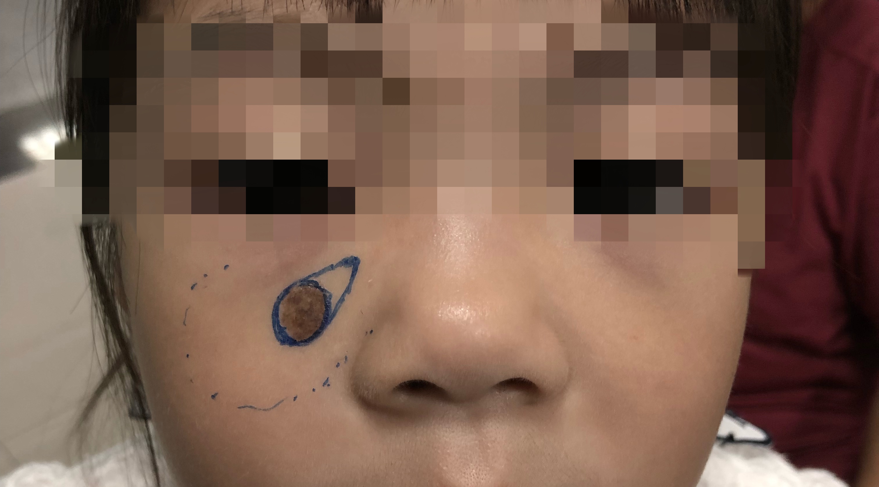 三厘米的痣手术切除要不要做皮瓣,头皮上有个凸起的痣要不要切除