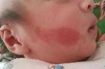 女生脸部常见皮肤问题,新生儿常见皮肤问题及护理试题