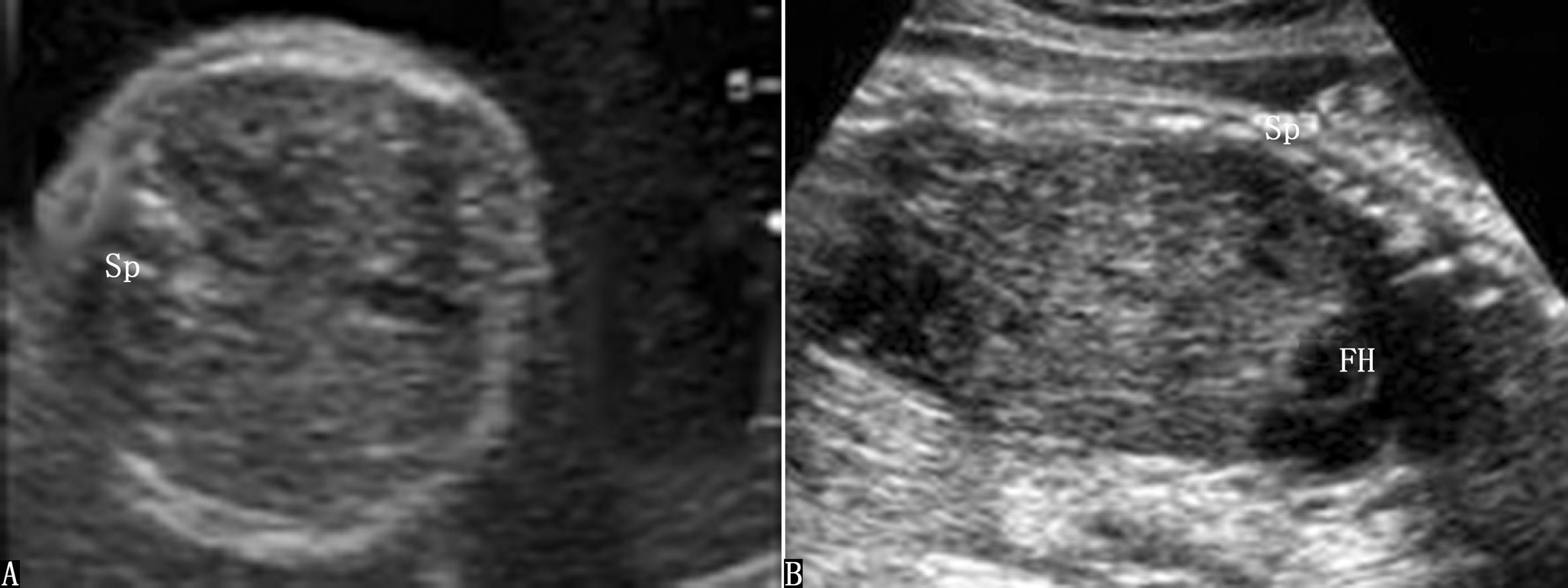 明明白白做超声28-1胎儿消化系统畸形：食道闭锁