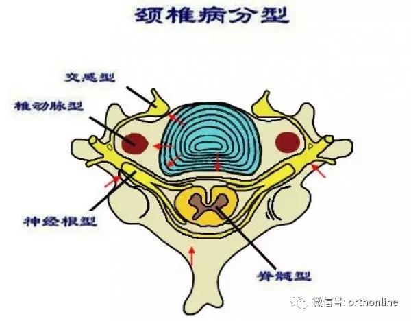 颈椎显微微创手术的利与弊