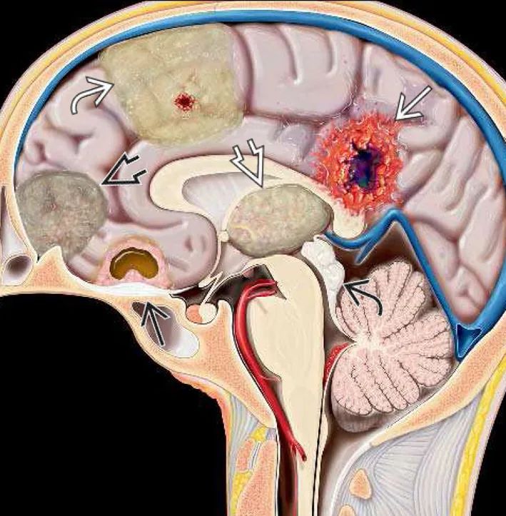 脑子里有4毫米的瘤,脑子里为什么会长瘤