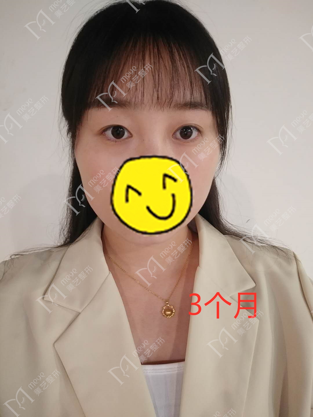 女子双眼皮术后大小眼,大小眼做了双眼皮感觉眼角不对称