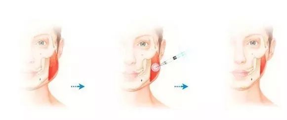 脸宽脸大怎么做,脸大该怎么办才可以瘦脸