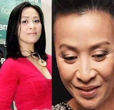 祛颈纹注射除皱和射频除皱哪个好,光电除皱和注射除皱哪个好啊