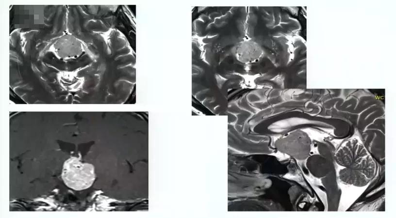 INC巴特朗菲教授视频|视神经-下丘脑胶质瘤全切案例集及治疗解读
