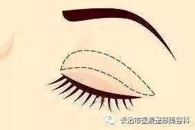 揭秘整形双眼皮内幕,割双眼皮术的价格