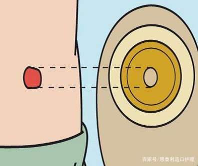 结肠癌造口术后胀气怎么回事,结肠癌手术后造口间歇性流血