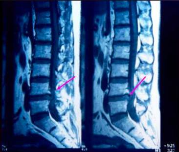 腰椎间盘突出症的临床诊治策略,腰椎间盘突出症的临床诊治