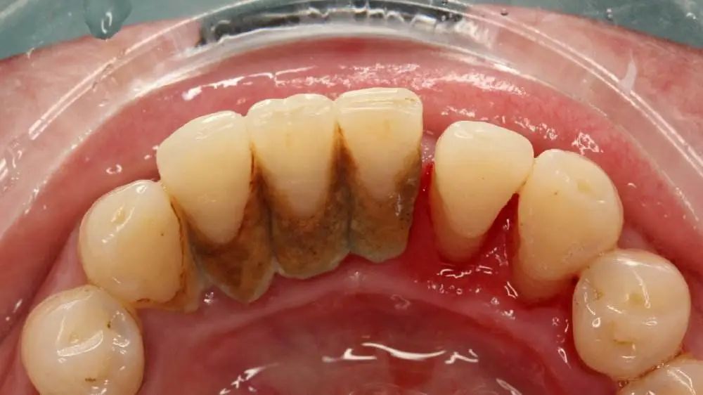 牙龈萎缩出血洗牙能治吗,洗牙后吃硬物仍牙龈出血