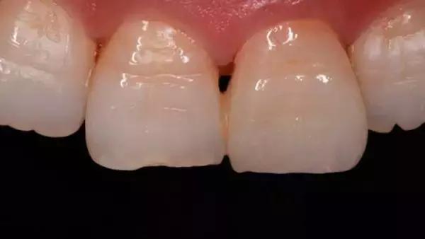 青少年整牙会出现黑三角吗,上牙有黑三角吗