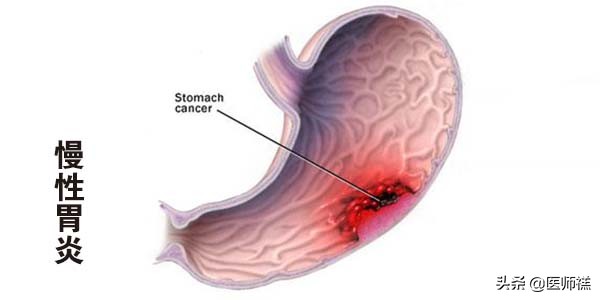 胃炎迁延不愈,胃炎久治不愈需要再做胃镜吗