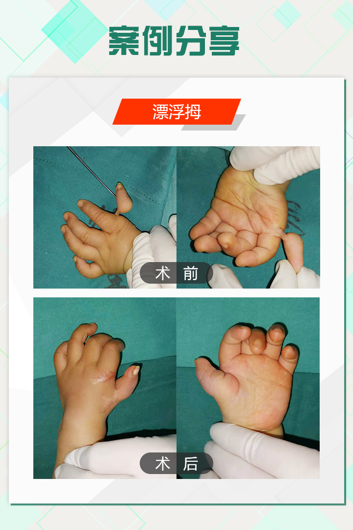 手足外科陈江海微博,手外科专家陈江海