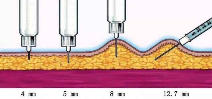 为什么先注射胰岛素再注射葡萄糖,胰岛素注射笔使用方法及注射部位