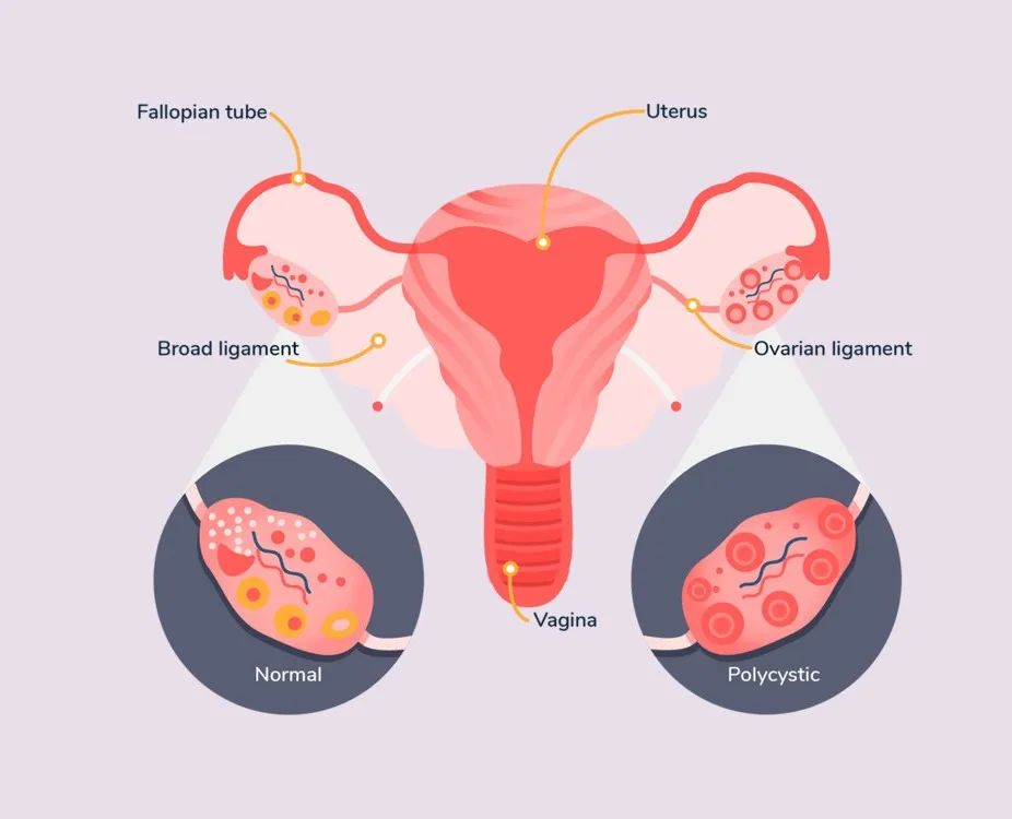 肠道菌群移植治疗肠道易激综合征,多囊卵巢综合征与肠道菌群紊乱