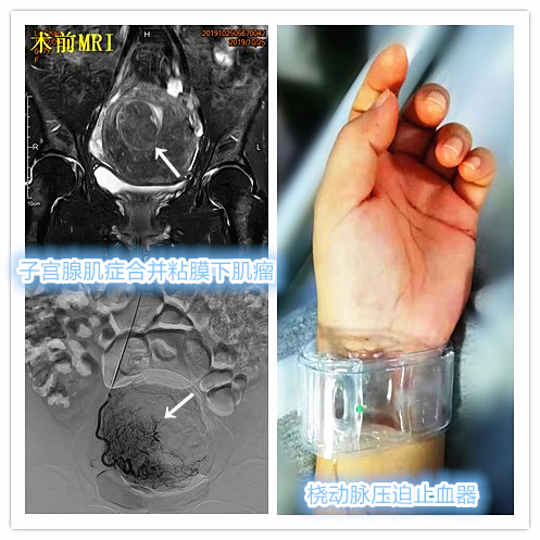 子宫腺肌症介入栓塞全国哪里好,子宫腺肌症介入栓塞治疗报销吗