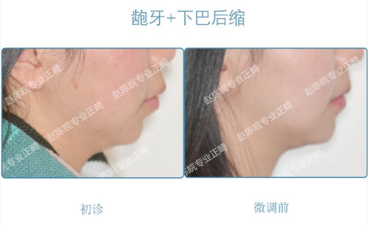 杭州成人隐形矫正牙齿优惠,矫正牙齿杭州无创伤