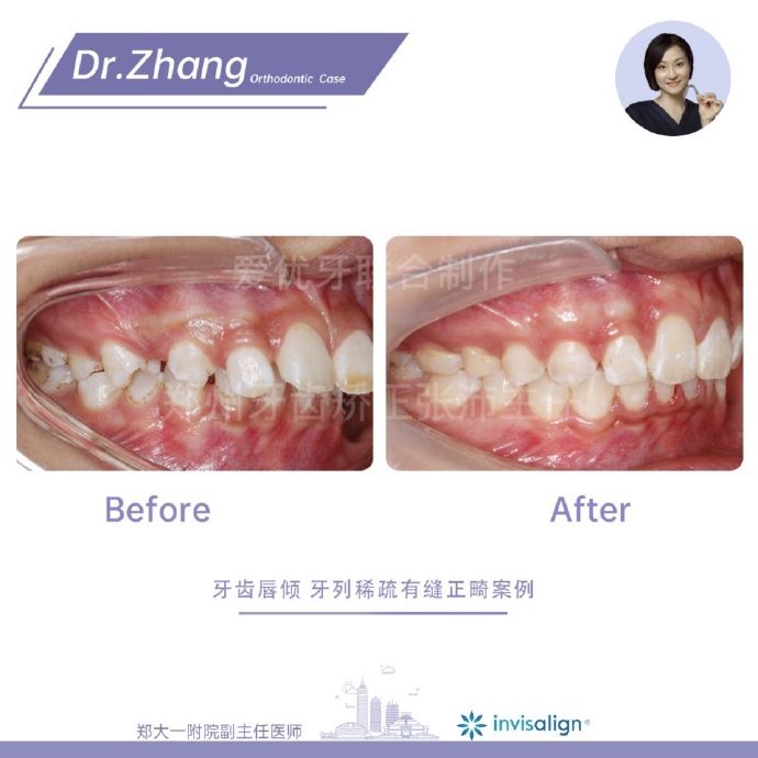 郑州矫正牙齿整形哪个医院好,郑州牙齿局部矫正