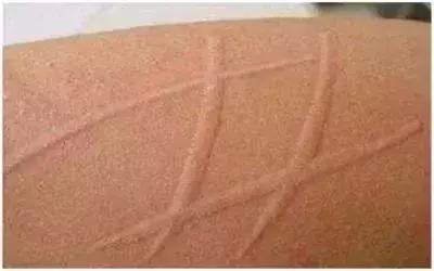 儿童得了寒冷性荨麻疹怎么治疗,儿童荨麻疹风团禁吃什么