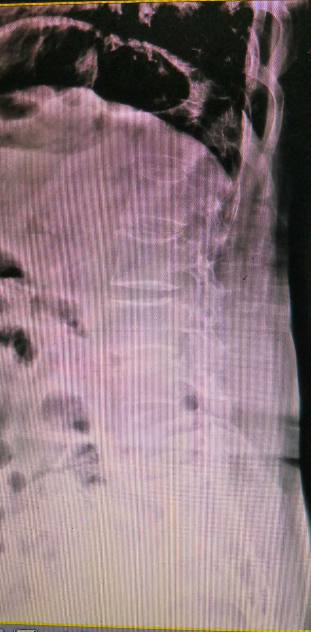 腰椎滑脱做开放手术需要多少费用,腰椎滑脱微创和开放手术哪个好