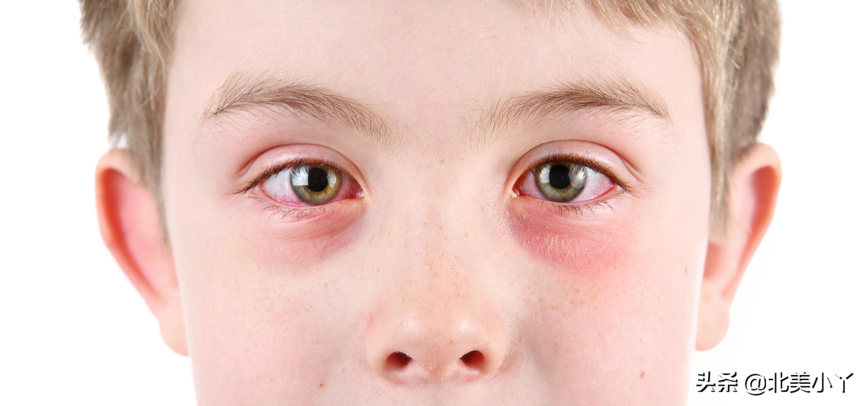 小孩眼周红肿有眼屎,小丫说医