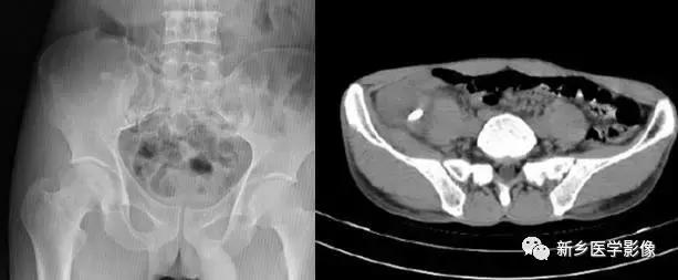 左肾可见高密度影不是结石,结节状高密度影是结石吗