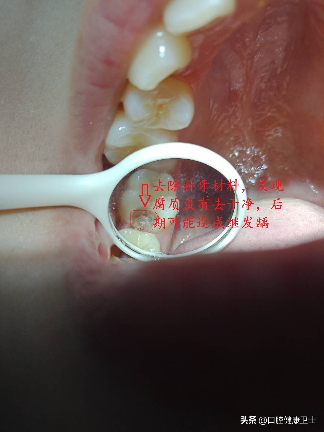 补牙后的牙缝越来越大怎么办,补牙之后牙缝塞东西导致牙龈痛