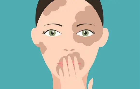 白斑和白癜风的鉴别方法,白癜风和日光性白斑鉴别诊断