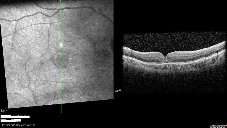 眼球晶体破洞,眼球裂缝是什么原因造成的
