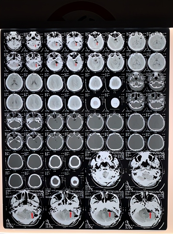 头晕耳鸣听力下降,头晕脑胀听力下降怎么回事