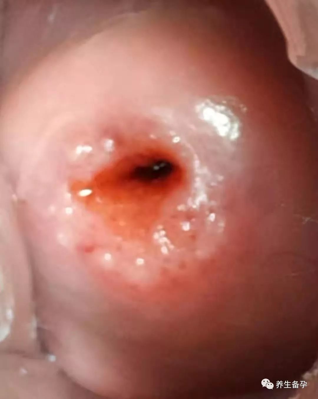 精子被堵在起跑线了的原因