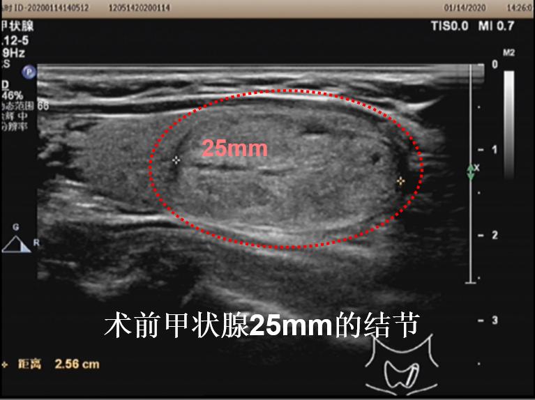 哈尔滨微创消融甲状腺结节哪家好,甲状腺结节微创消融术的过程